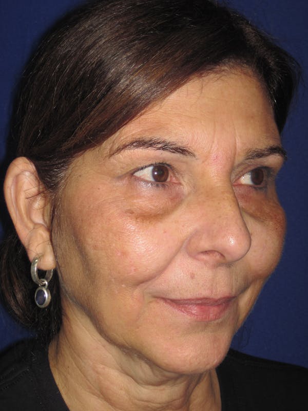 Laser Skin Resurfacing Before & After Gallery - Patient 4891046 - Image 5