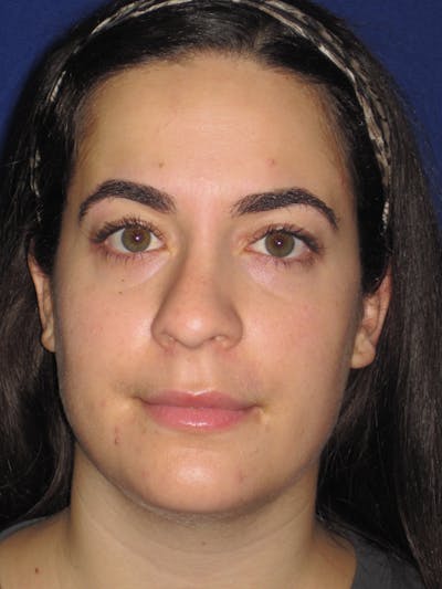 Rhinoplasty Before & After Gallery - Patient 4891051 - Image 1
