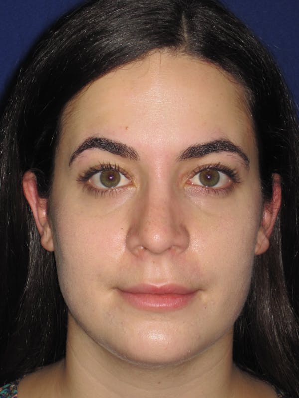 Rhinoplasty Before & After Gallery - Patient 4891051 - Image 2