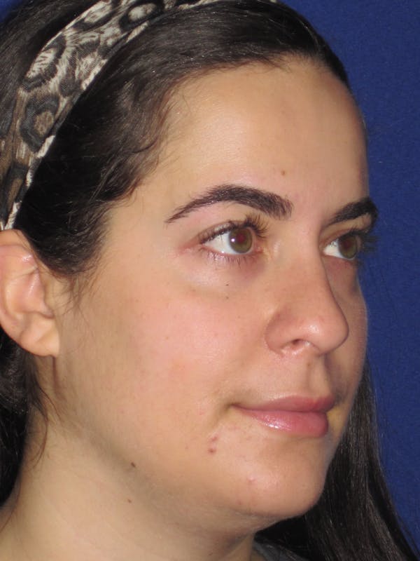 Rhinoplasty Before & After Gallery - Patient 4891051 - Image 3