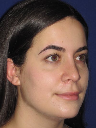 Rhinoplasty Before & After Gallery - Patient 4891051 - Image 4