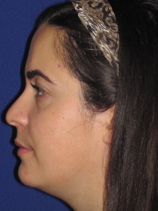 Rhinoplasty Before & After Gallery - Patient 4891051 - Image 5