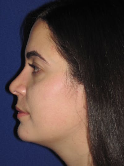 Rhinoplasty Before & After Gallery - Patient 4891051 - Image 6