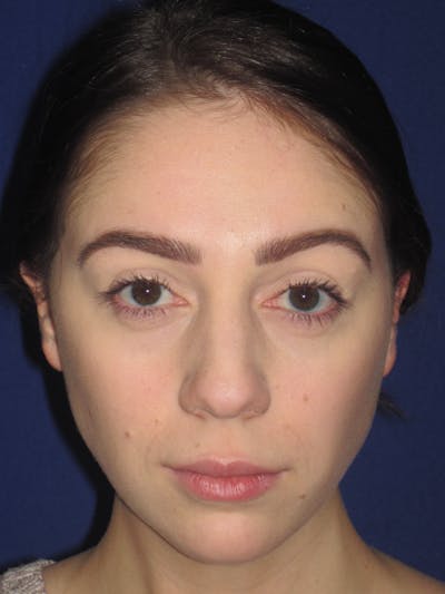 Rhinoplasty Before & After Gallery - Patient 4891063 - Image 1