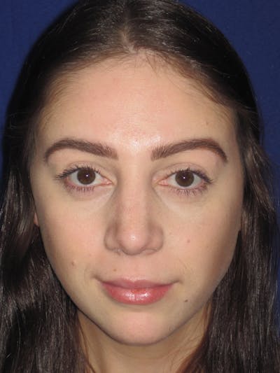Rhinoplasty Before & After Gallery - Patient 4891063 - Image 2