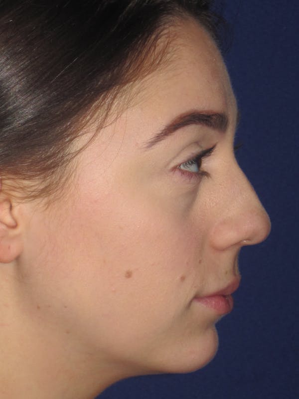 Rhinoplasty Before & After Gallery - Patient 4891063 - Image 3