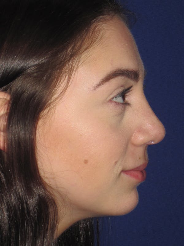 Rhinoplasty Before & After Gallery - Patient 4891063 - Image 4