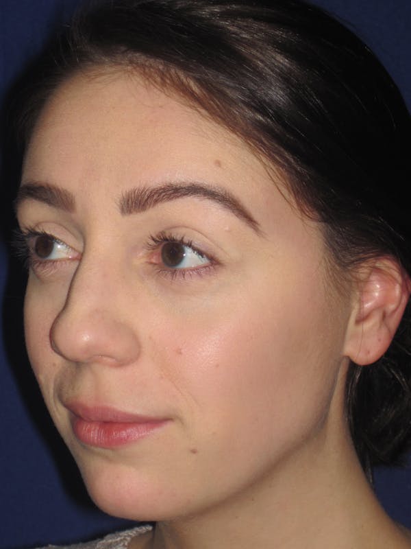Rhinoplasty Before & After Gallery - Patient 4891063 - Image 5