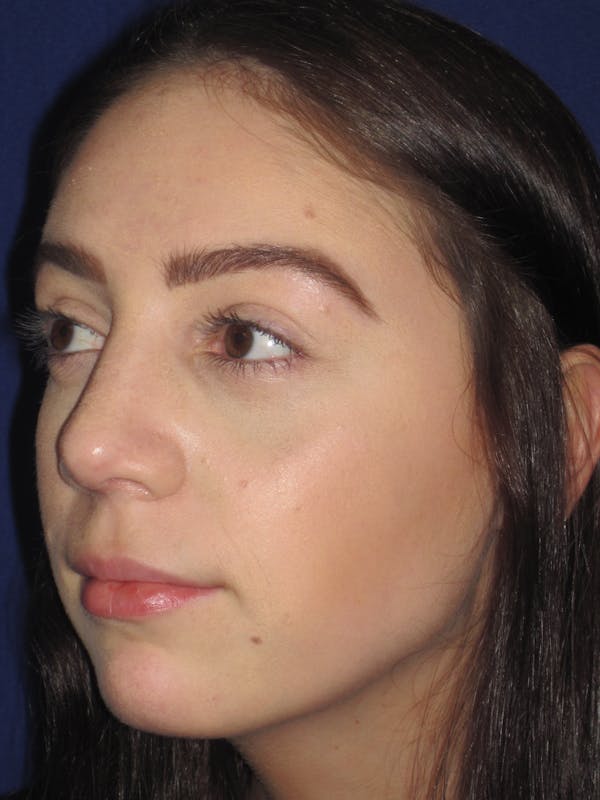 Rhinoplasty Before & After Gallery - Patient 4891063 - Image 6