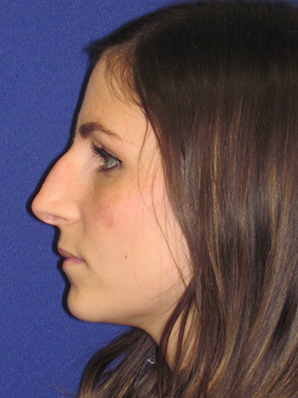 Rhinoplasty Before & After Gallery - Patient 4891068 - Image 1