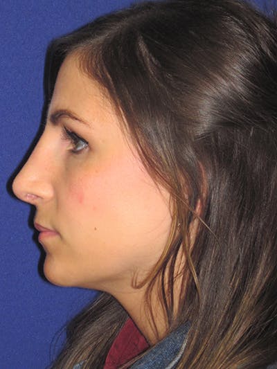Rhinoplasty Before & After Gallery - Patient 4891068 - Image 2