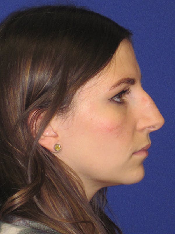 Rhinoplasty Before & After Gallery - Patient 4891068 - Image 3