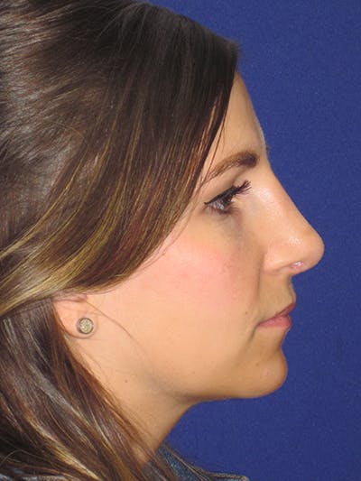 Rhinoplasty Before & After Gallery - Patient 4891068 - Image 4