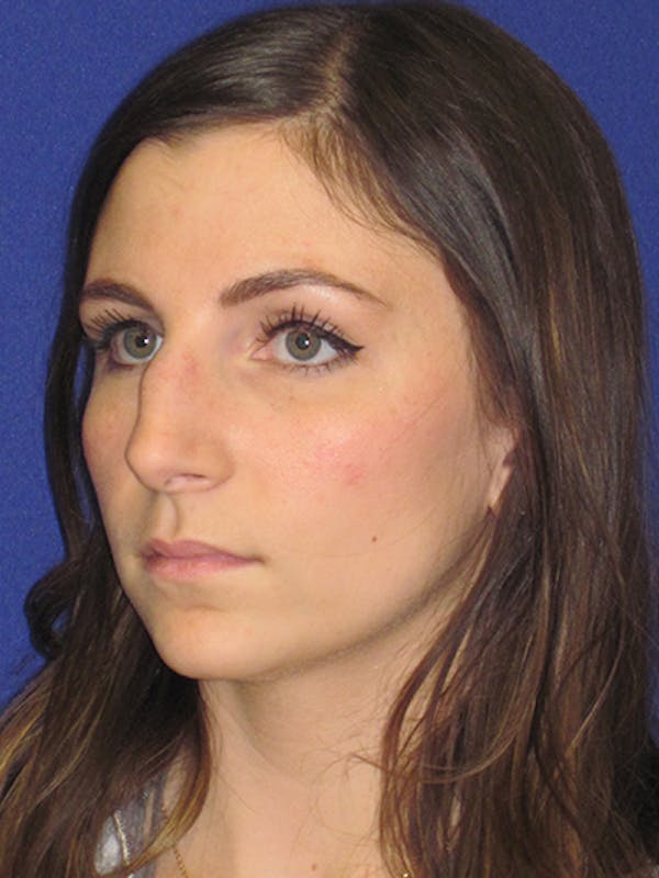 Rhinoplasty Before & After Gallery - Patient 4891068 - Image 5