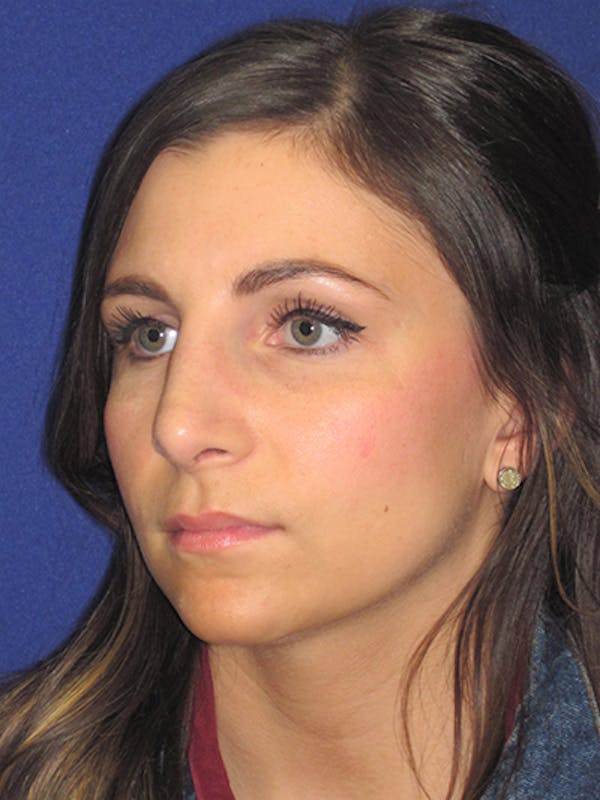 Rhinoplasty Before & After Gallery - Patient 4891068 - Image 6