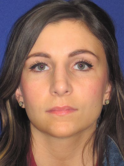Rhinoplasty Before & After Gallery - Patient 4891068 - Image 8
