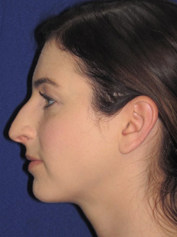 Rhinoplasty Before & After Gallery - Patient 4891072 - Image 1