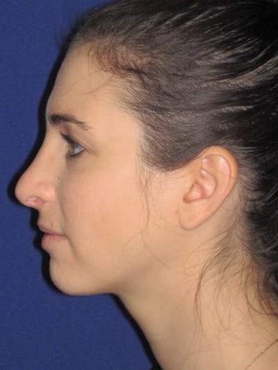 Rhinoplasty Before & After Gallery - Patient 4891072 - Image 2