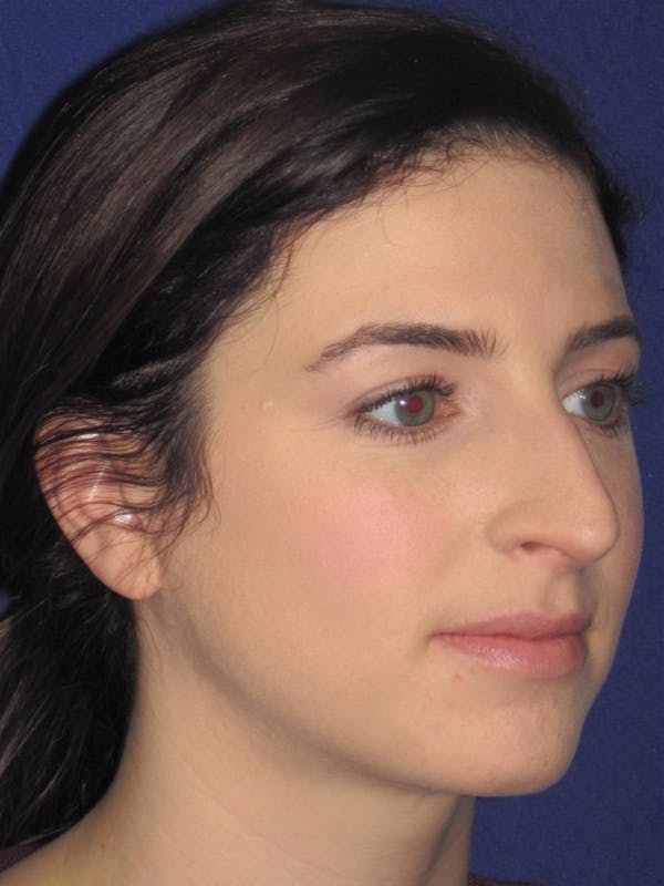 Rhinoplasty Before & After Gallery - Patient 4891072 - Image 3