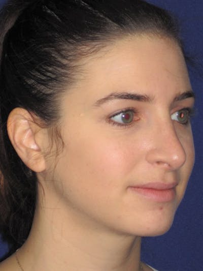 Rhinoplasty Before & After Gallery - Patient 4891072 - Image 4