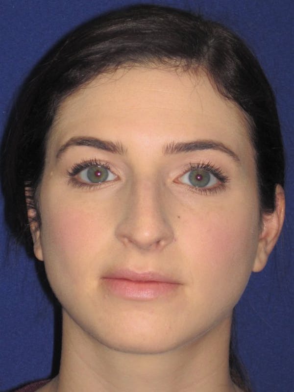 Rhinoplasty Before & After Gallery - Patient 4891072 - Image 5