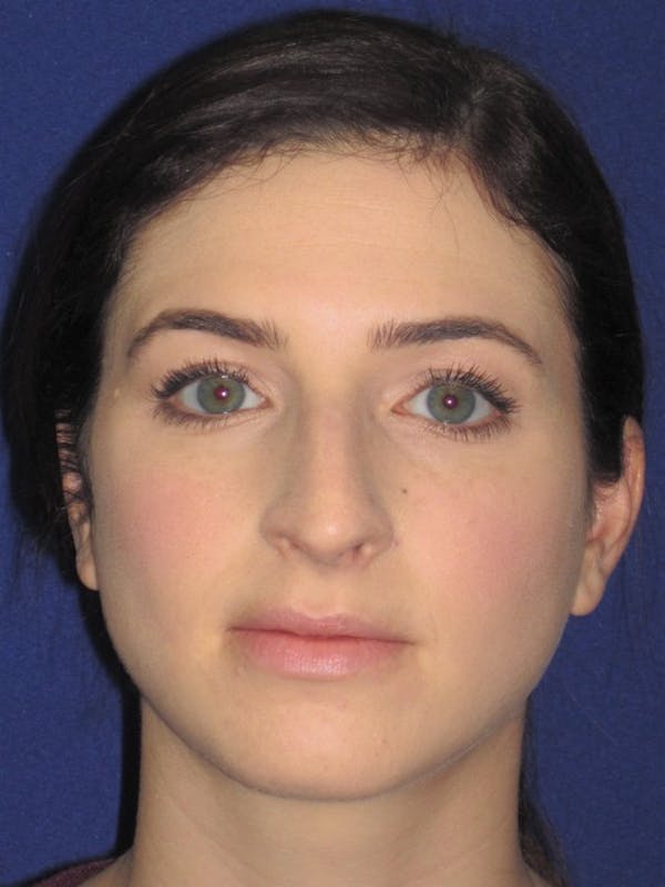 Rhinoplasty Gallery - Patient 4891072 - Image 5