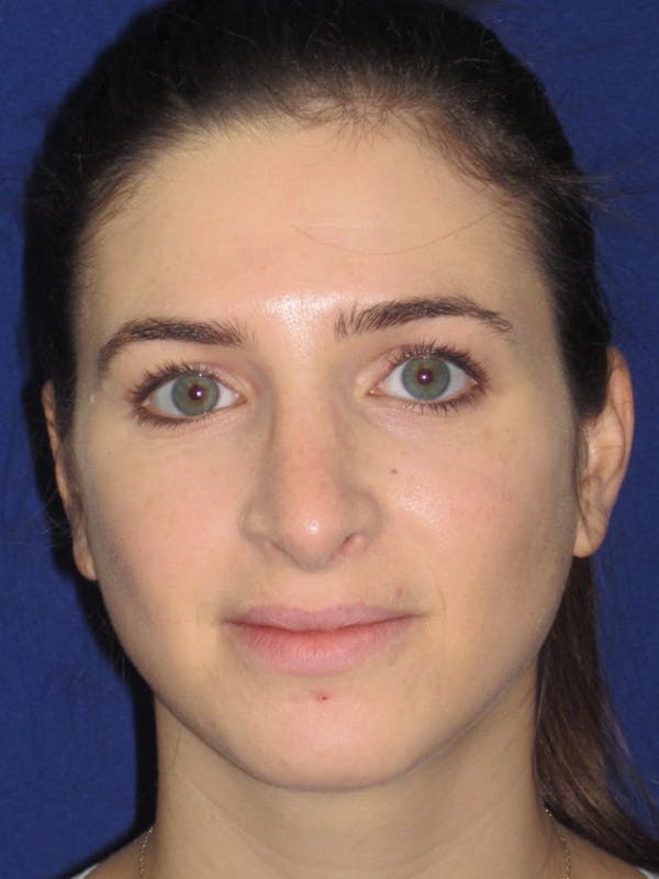 Rhinoplasty Before & After Gallery - Patient 4891072 - Image 6