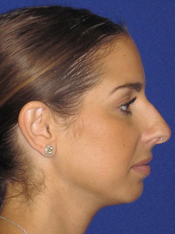 Rhinoplasty Before & After Gallery - Patient 4891077 - Image 1