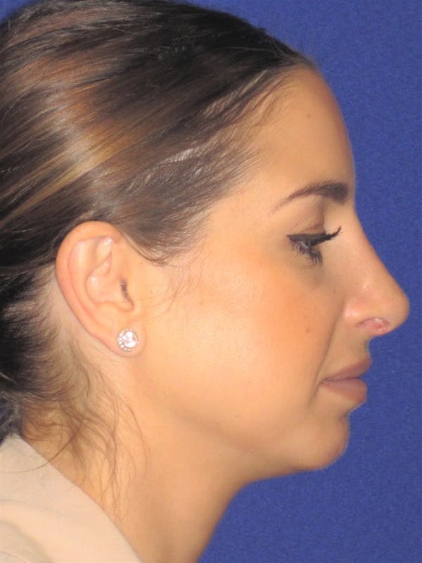 Rhinoplasty Before & After Gallery - Patient 4891077 - Image 2