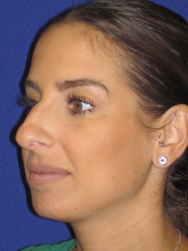 Rhinoplasty Before & After Gallery - Patient 4891077 - Image 3