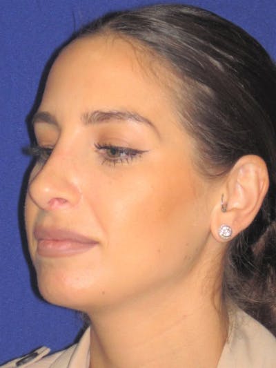 Rhinoplasty Before & After Gallery - Patient 4891077 - Image 4