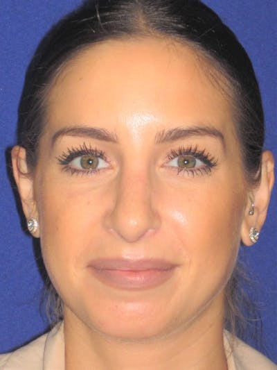 Rhinoplasty Before & After Gallery - Patient 4891077 - Image 6