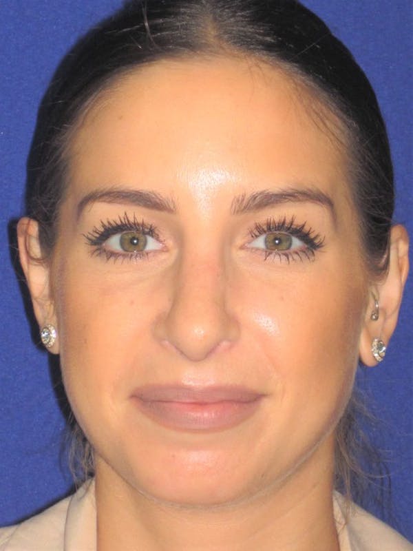 Rhinoplasty Before & After Gallery - Patient 4891077 - Image 6