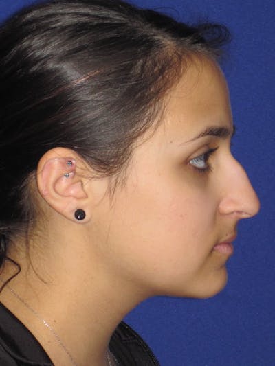 Rhinoplasty Before & After Gallery - Patient 4891080 - Image 1