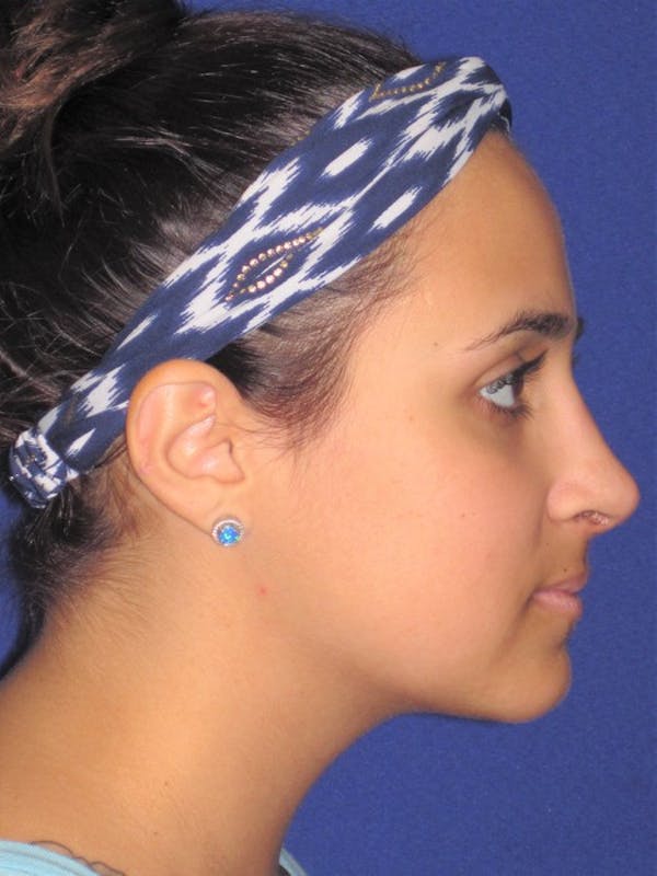 Rhinoplasty Before & After Gallery - Patient 4891080 - Image 2