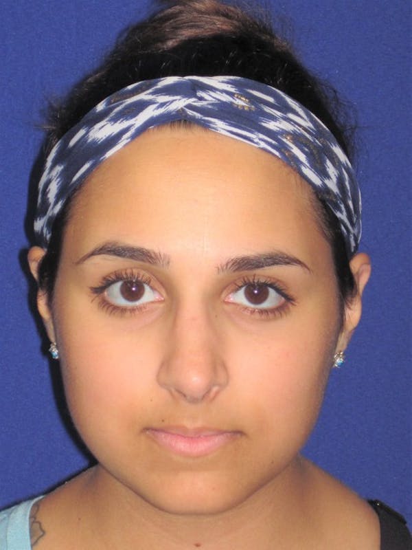 Rhinoplasty Before & After Gallery - Patient 4891080 - Image 4