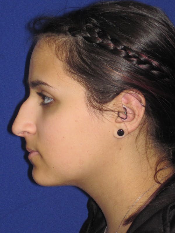 Rhinoplasty Before & After Gallery - Patient 4891080 - Image 5