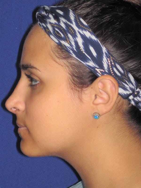 Rhinoplasty Before & After Gallery - Patient 4891080 - Image 6