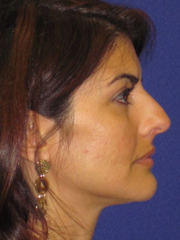 Rhinoplasty Before & After Gallery - Patient 4891085 - Image 1