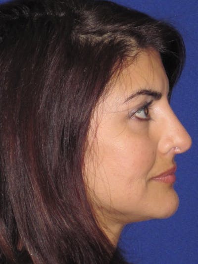 Rhinoplasty Before & After Gallery - Patient 4891085 - Image 2