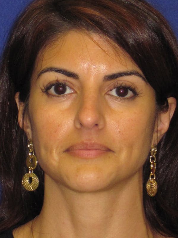 Rhinoplasty Before & After Gallery - Patient 4891085 - Image 7