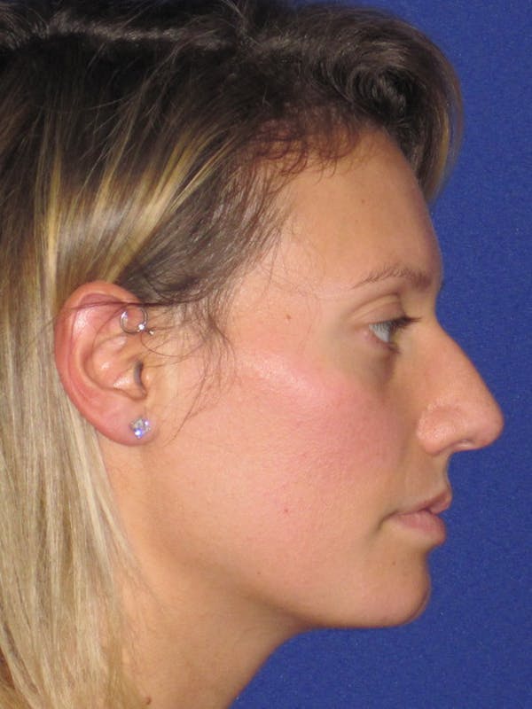 Rhinoplasty Before & After Gallery - Patient 4891091 - Image 1