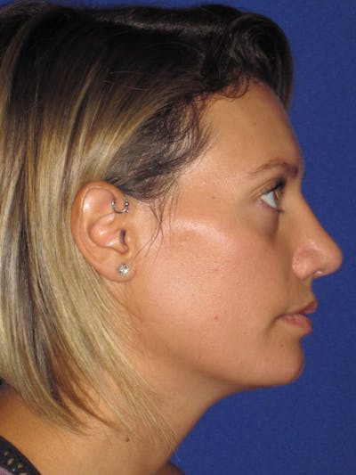 Rhinoplasty Before & After Gallery - Patient 4891091 - Image 2