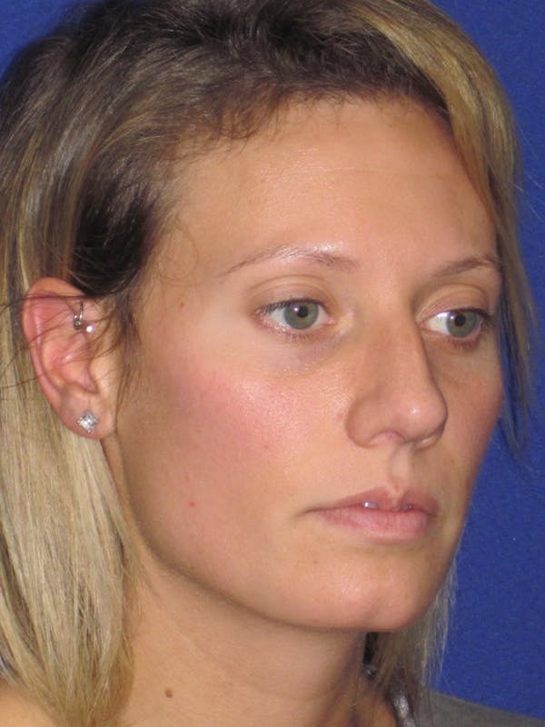 Rhinoplasty Before & After Gallery - Patient 4891091 - Image 3