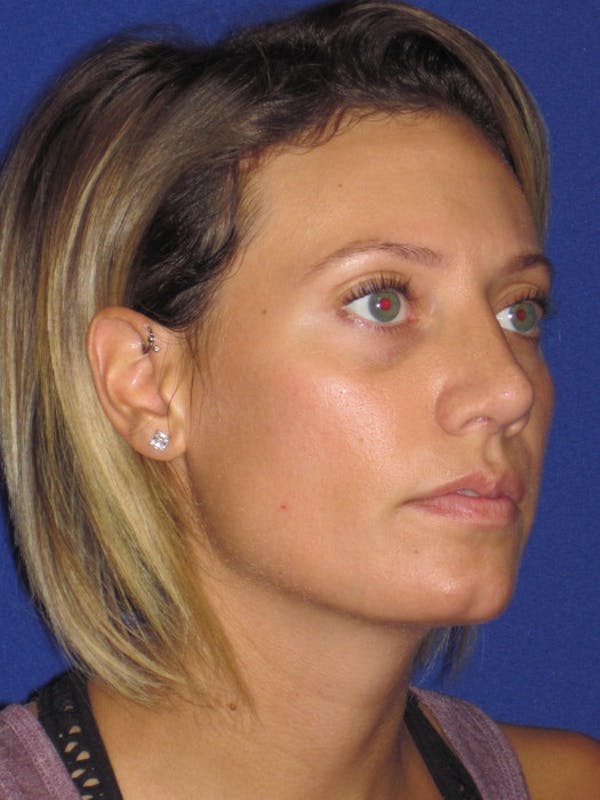 Rhinoplasty Before & After Gallery - Patient 4891091 - Image 4