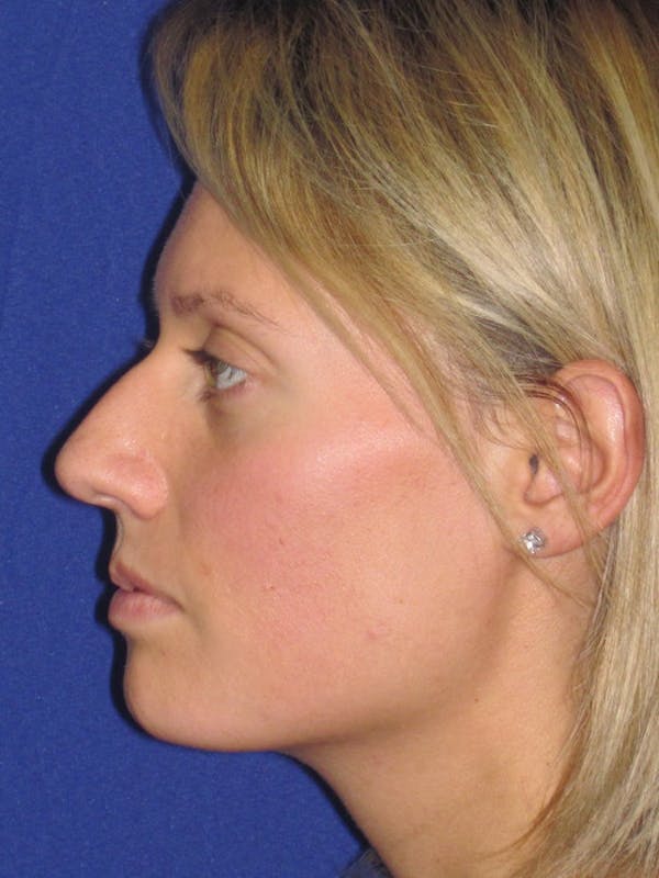 Rhinoplasty Before & After Gallery - Patient 4891091 - Image 5