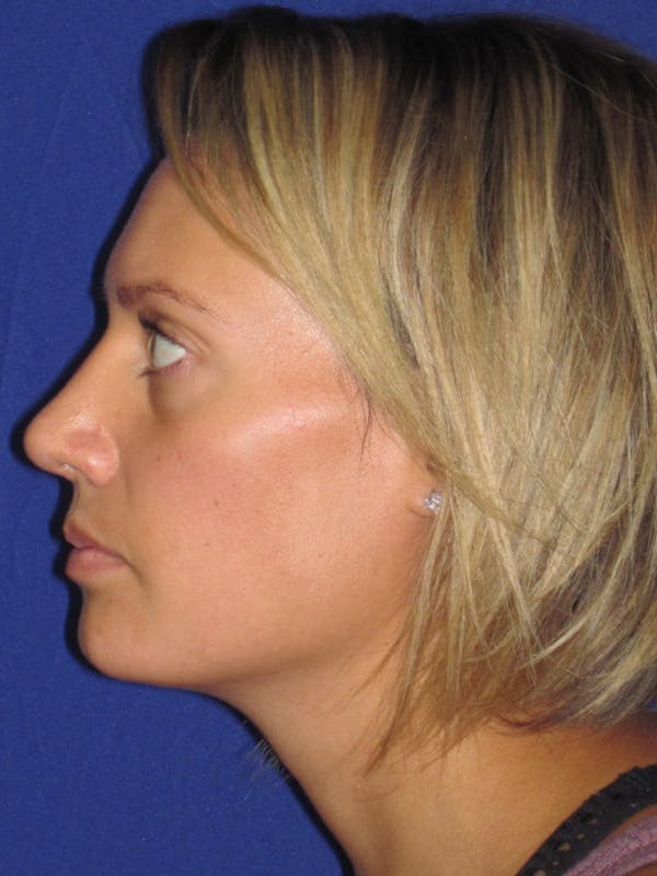 Rhinoplasty Before & After Gallery - Patient 4891091 - Image 6
