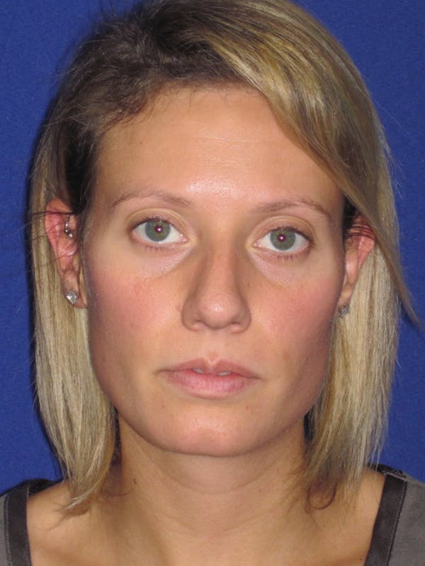 Rhinoplasty Before & After Gallery - Patient 4891091 - Image 7