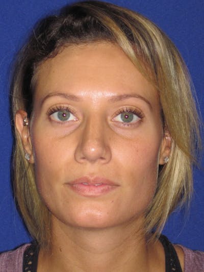 Rhinoplasty Before & After Gallery - Patient 4891091 - Image 8