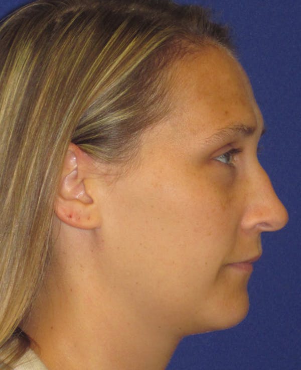Rhinoplasty Before & After Gallery - Patient 4891145 - Image 3